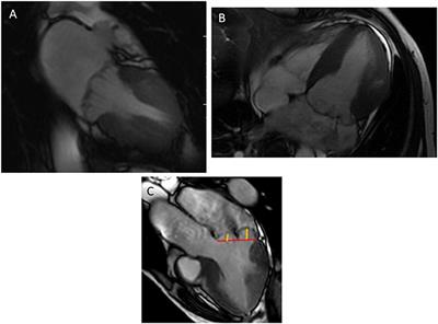 The evolving role of cardiovascular magnetic resonance in the assessment of mitral valve prolapse